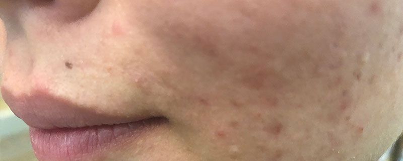 学生怎样去痘痘和痘印