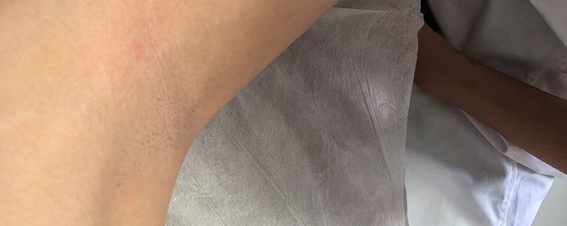 腋下很黑怎么办怎样才能变白