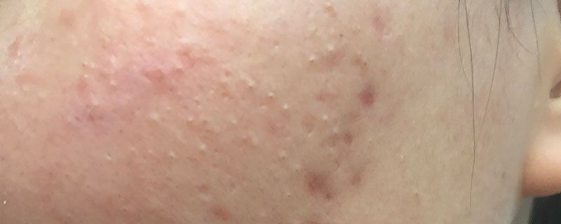 掉痂后红印子能敷面膜吗