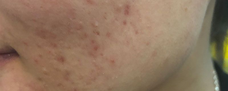 脸上有痘印毛孔粗大怎么办